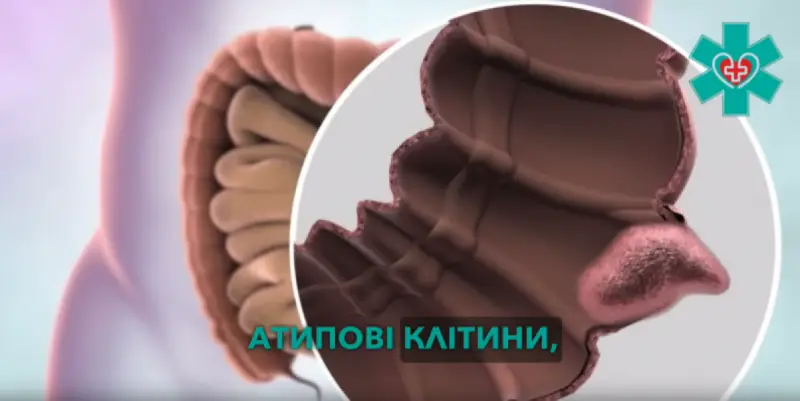  У Кременчуці закликають не зволікати з обстеженням: лікар пояснив, як вчасно виявити передракові стани